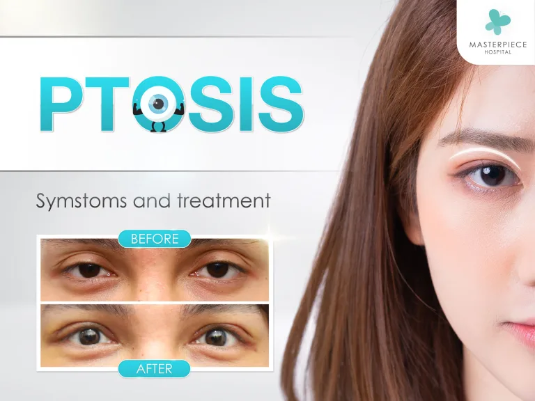 What can cause Ptosis