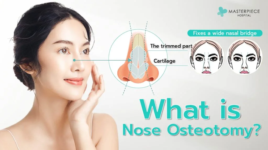 Apa itu osteotomi hidung?