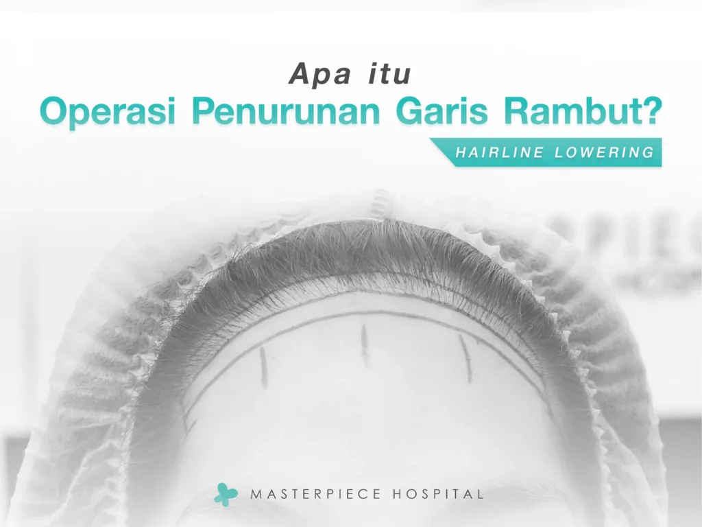 Apa itu Menggeser Garis Rambut dan Mengecilkan Dahi