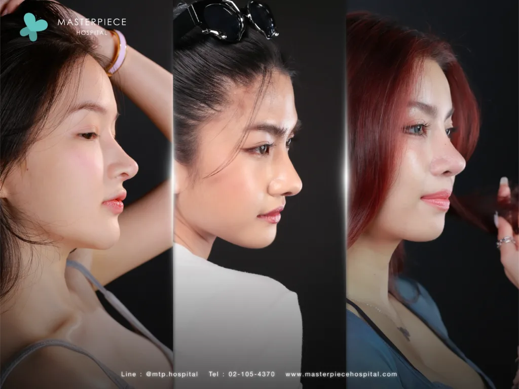 Rhinoplasty Open