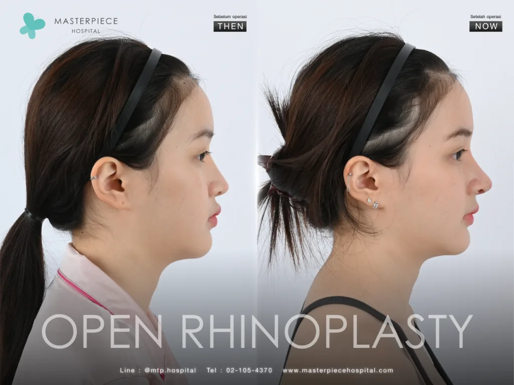 NOSE RECONSTRUCTION