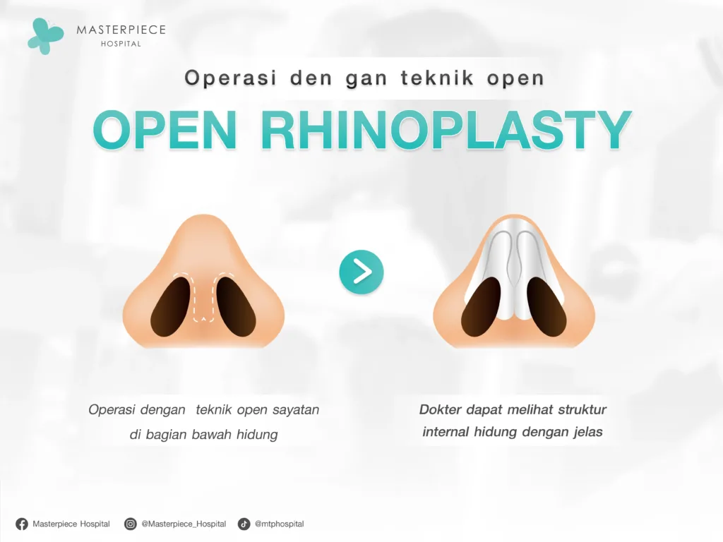 Apa Itu Teknik Operasi Struktur Hidung