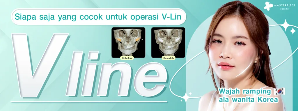 Siapa yang Cocok untuk Operasi V Line 3 Titik?