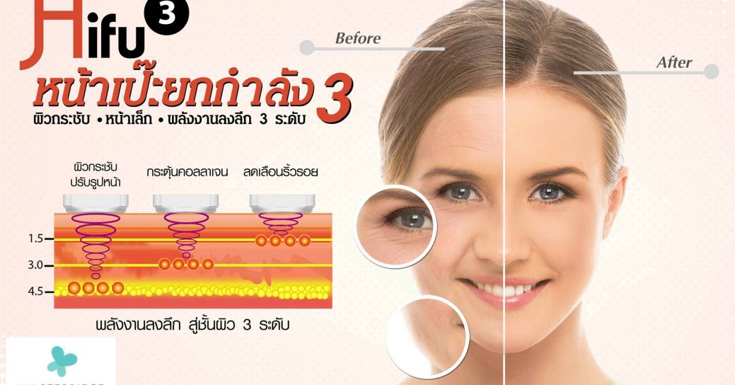 Hifu3-เป๊ะยกกำลัง3-MTP