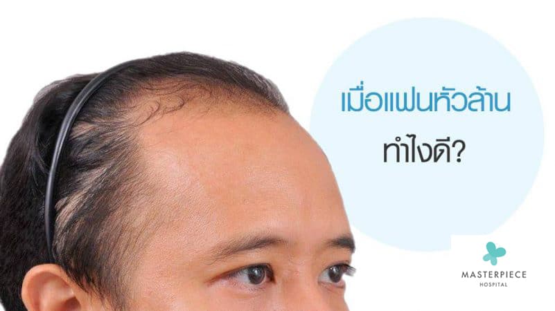 เมื่อแฟนหัวล้านทำไงดี?