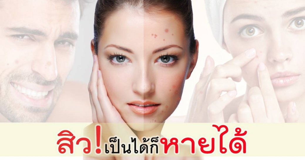 สิว!เป็นได้ก็หายได้