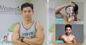 ปลูกผมที่ Masterpiece Hospital