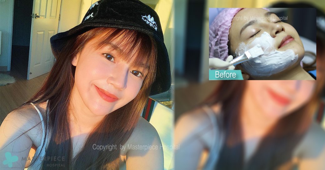 Thermage 300 shots ยกกระชับหน้าเรียวพร้อมลดไซซ์แก้ม – คุณแพน (พิธีกรรายการลิ้นติดโปร)