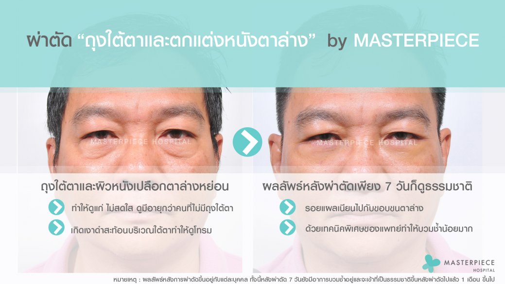 BA ใต้ตา ผู้ชาย BA ใต้ตา ผู้ชาย