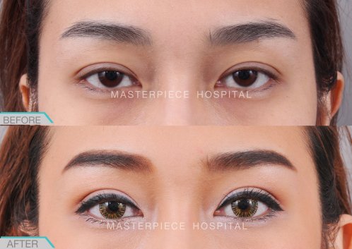eye-ptosis-BA-02 eye-ptosis-BA-02