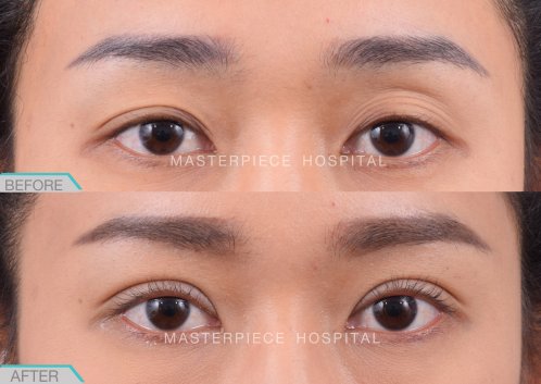 eye-ptosis-BA-03 eye-ptosis-BA-03