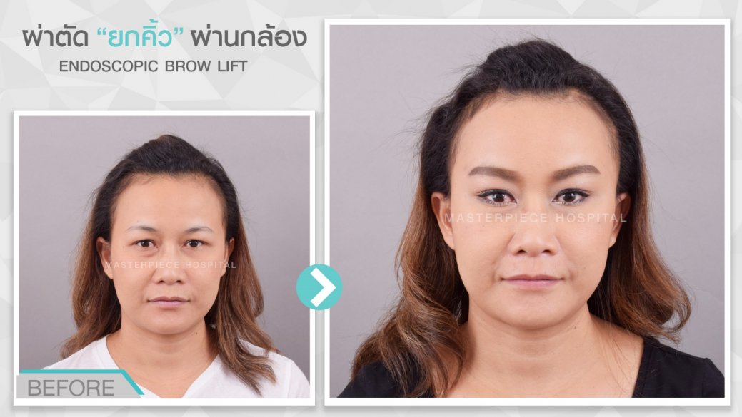 ๋ผ่าตัด ยกคิ้ว ผ่านกล้อง ๋ผ่าตัด ยกคิ้ว ผ่านกล้อง
