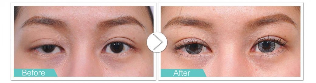 ptosis-masterpiece-1 ptosis-masterpiece-1