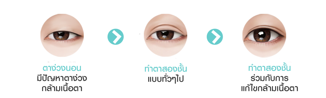 ptosis ตา 3 อัน ptosis ตา 3 อัน
