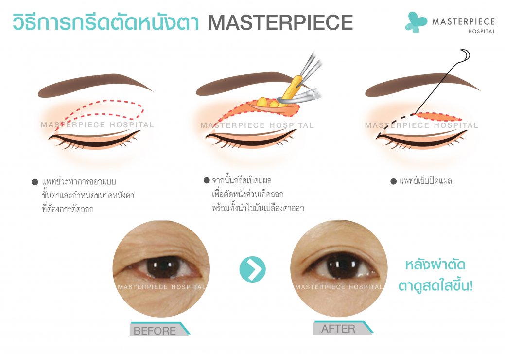 วิธีการกรีดตาบนแก้ตาตก วิธีการกรีดตาบนแก้ตาตก