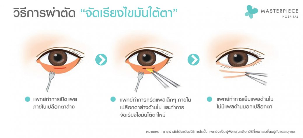 วิธีจัดเรียงไขมันใต้ตา วิธีจัดเรียงไขมันใต้ตา