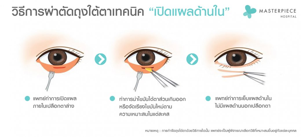 วิธีผ่าใต้ตาแผลใน วิธีผ่าใต้ตาแผลใน