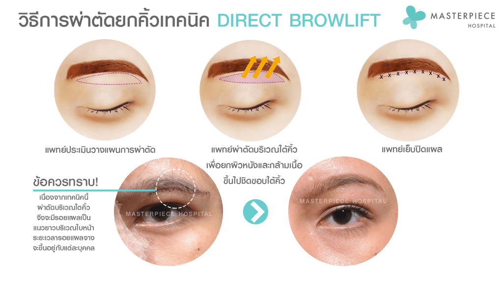 วิธีการผ่าตัดยกคิ้วเทคนิค Direct Browlift