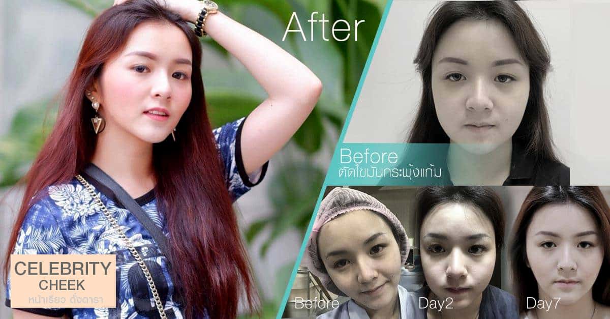 รีวิว ตัดไขมันกระพุ้งแก้มก่อนและหลังทำ
หลังทำไป 2 วัน แก้มยังบวมจากการผ่าตัด
หลังทำไป 7 วัน รูปหน้าเริ่มเข้าที่
หลังทำไป 1 สัปดาห์ หน้าเล็กเรียวเข้ารูป ไม่มีอาการบวม