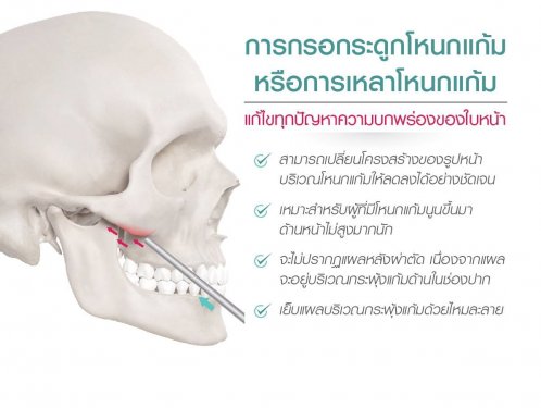 การกรอกกระดูกโหนกแก้ม การกรอกกระดูกโหนกแก้ม