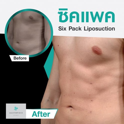ดูดไขมัน ซิกแพค (SIX PACK LIPOSUCTION) ดูดไขมัน ซิกแพค (SIX PACK LIPOSUCTION)