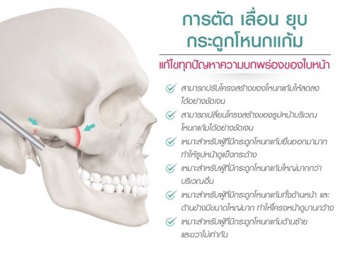 การตัด เลื่อน ยุบ กระดูกโหนกแก้ม การตัด เลื่อน ยุบ กระดูกโหนกแก้ม