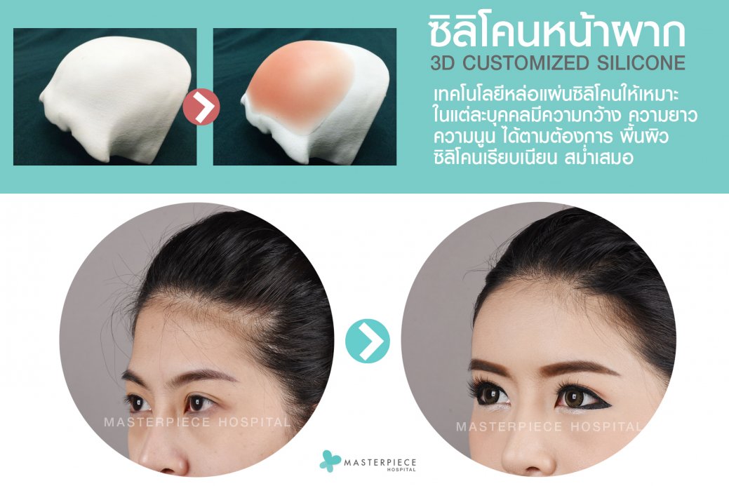 3D Customized Silicone Implant 3D Customized Silicone Implant