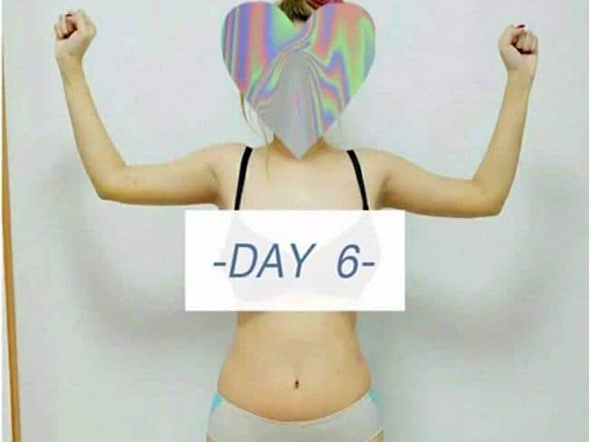 Day 6 After Arms Vaser Liposuction