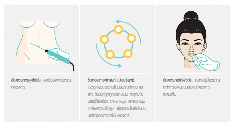 วิธีการศัลยกรรมเติมเต็มด้วยเซลล์ไขมันตัวเอง