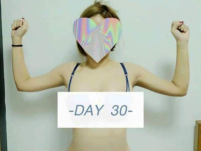 Day 30 After Arms Vaser Liposuction