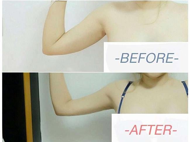My Arms Vaser Liposuction Amazing Results!