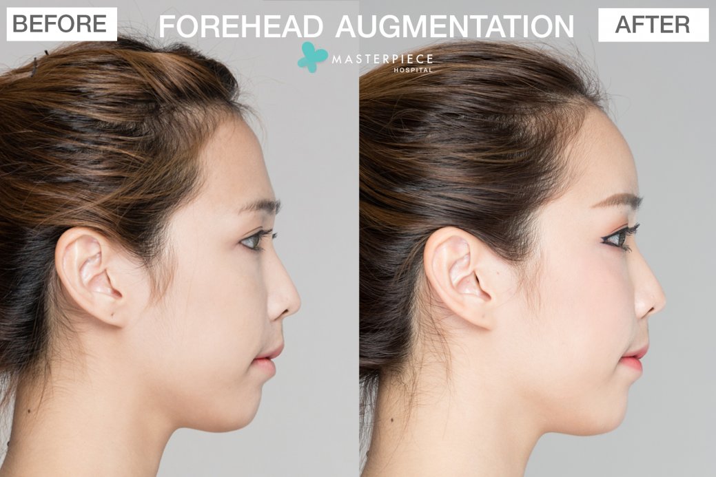 FORHEAD AUGMENTATION