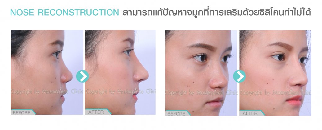 การทำจมูกด้วยเทคนิคปรับโครงสร้าง NOSE RECONSTRUCTION การทำจมูกด้วยเทคนิคปรับโครงสร้าง NOSE RECONSTRUCTION
