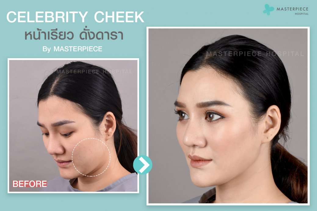 ตัดไขมันกระพุ้งแก้ม (CELEBRITY CHEEK) ตัดไขมันกระพุ้งแก้ม (CELEBRITY CHEEK)