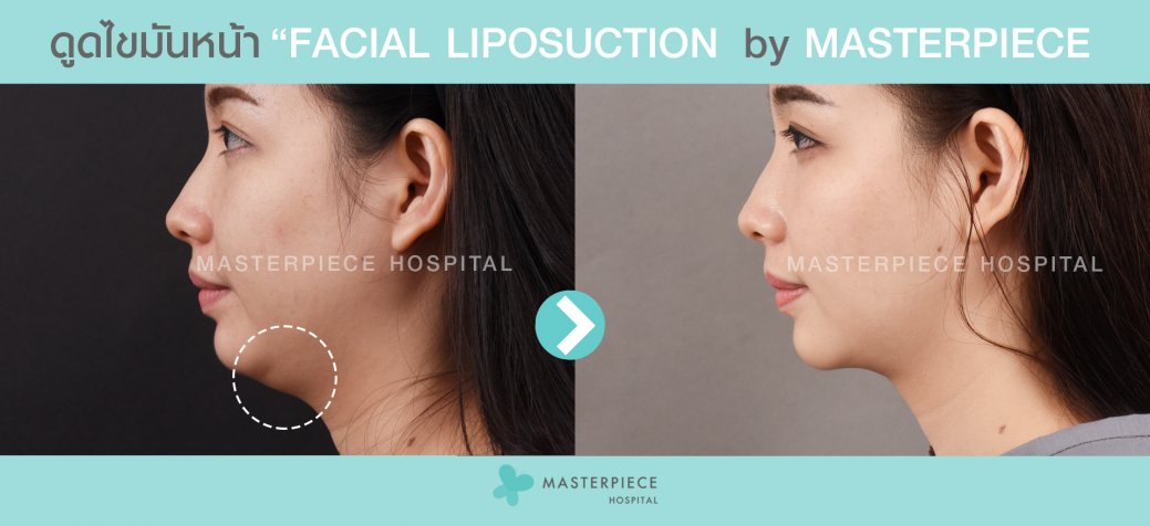 ก่อนหลัง ดูดไขมันหน้า Facial Vaser Liposuction ก่อนหลัง ดูดไขมันหน้า Facial Vaser Liposuction
