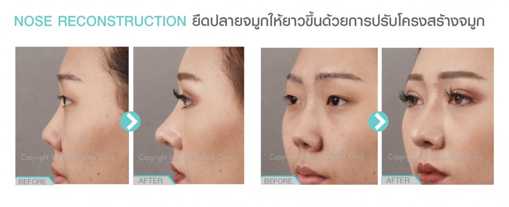 การปรับโครงสร้างจมูก การปรับโครงสร้างจมูก