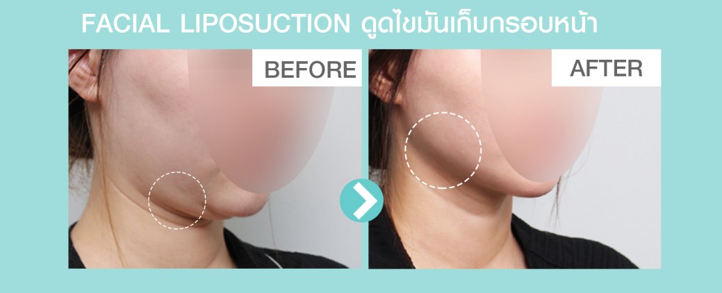 รีวิวก่อนหลังดูดไขมันหน้า รีวิวก่อนหลังดูดไขมันหน้า