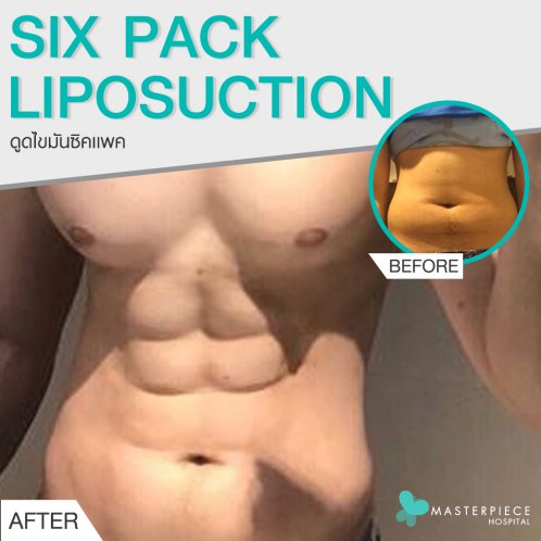 ดูดไขมัน ซิกแพค (SIX PACK LIPOSUCTION) ดูดไขมัน ซิกแพค (SIX PACK LIPOSUCTION)