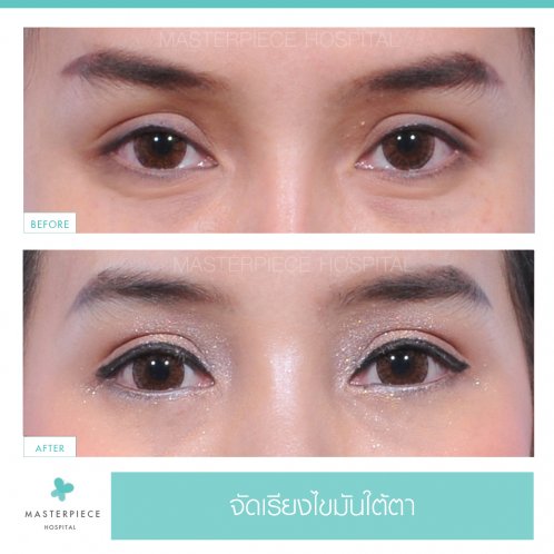 B&A ถุงใต้ตา B&A ถุงใต้ตา