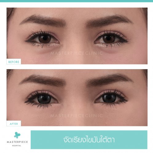 B&A ถุงใต้ตา B&A ถุงใต้ตา