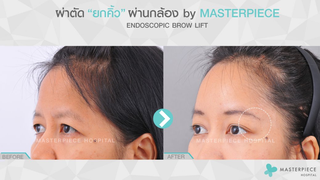 BA ยกคิ้ว 1 BA ยกคิ้ว 1