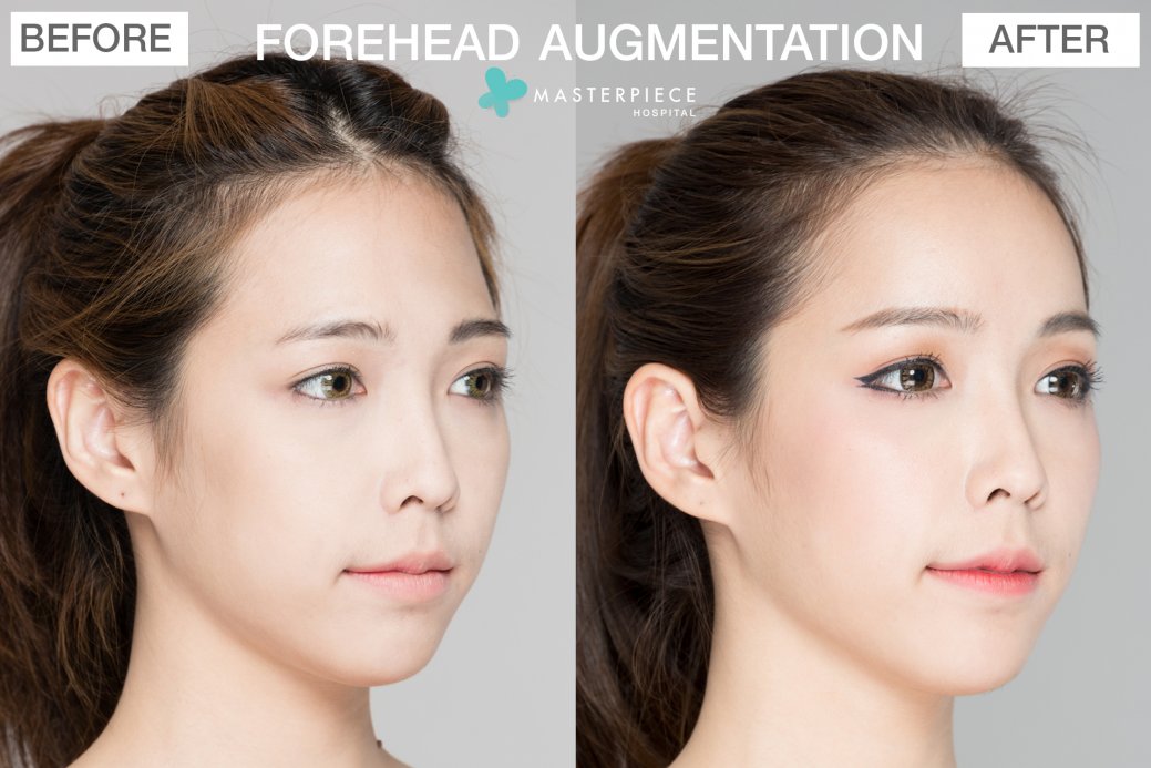 FOREHEAD AUGMENTATION FOREHEAD AUGMENTATION