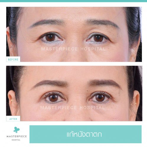B&A ถุงใต้ตา B&A ถุงใต้ตา