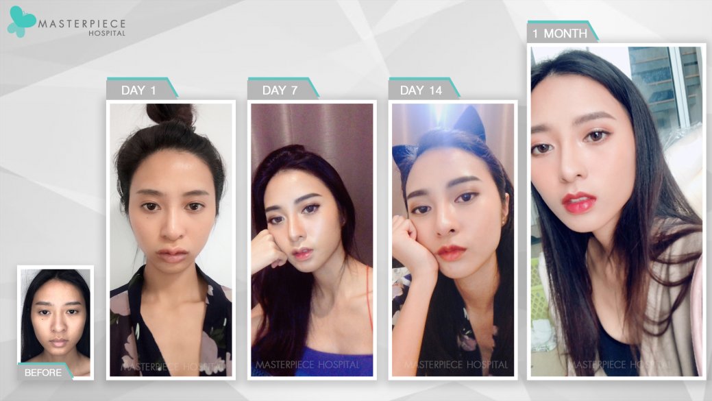 ศัลยกรรมปากกระจับรับใบหน้า ศัลยกรรมปากกระจับรับใบหน้า
