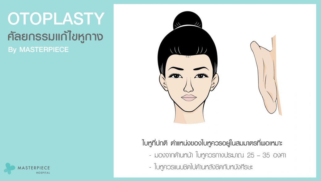 ศัลยกรรมแก้ไขหูกาง ศัลยกรรมแก้ไขหูกาง