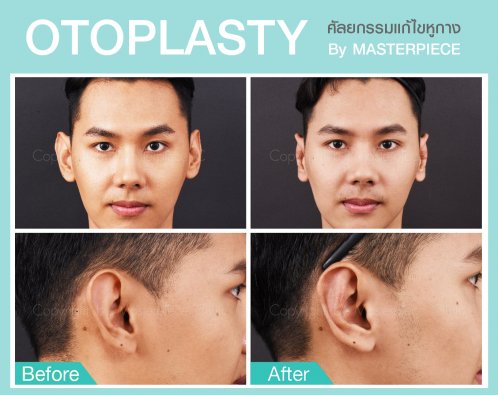 ศัลยกรรมแก้ไขจมูก ศัลยกรรมแก้ไขจมูก