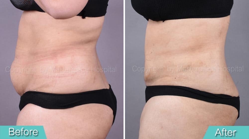 Tummy-tuck-ตัดหนังหน้าท้อง