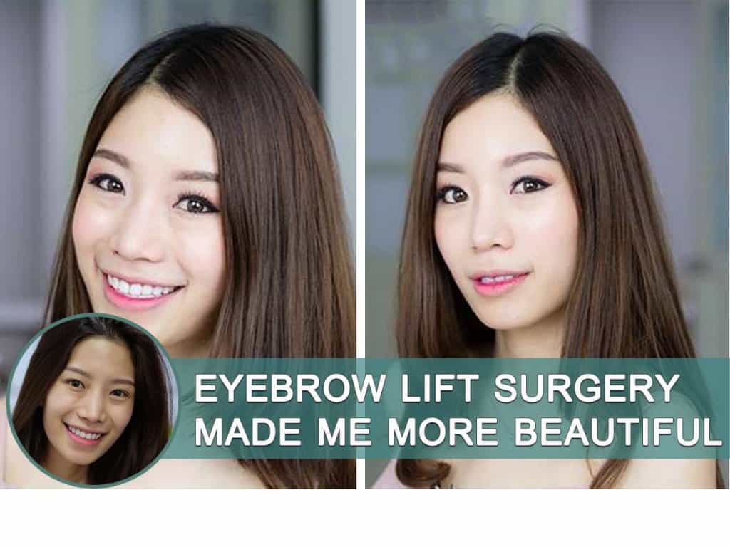 Eyebrow Lift Surgery
