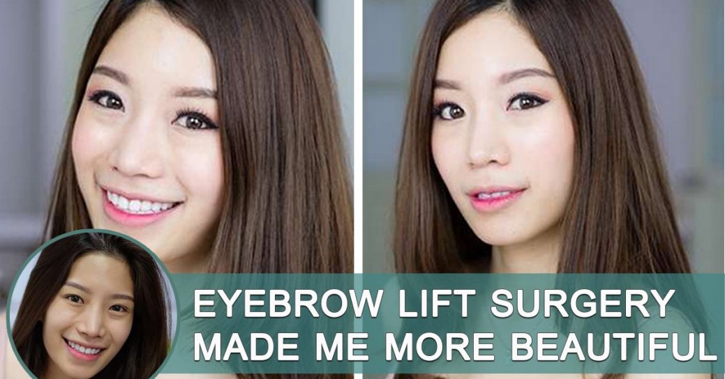 Eyebrow Lift Surgery