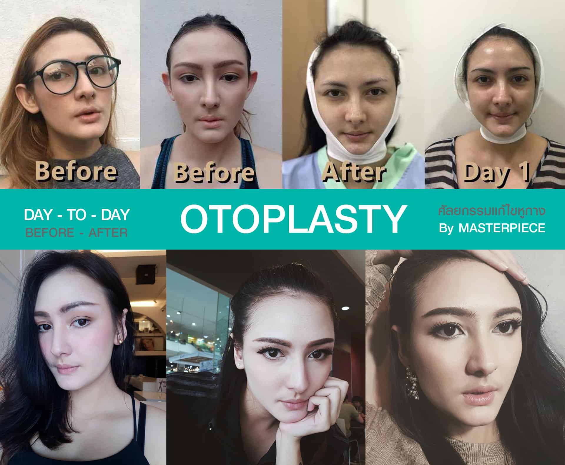 DAY TO DAY แก้ไขหูกาง (OTOPLASTY)